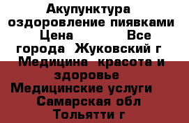 Акупунктура, оздоровление пиявками › Цена ­ 3 000 - Все города, Жуковский г. Медицина, красота и здоровье » Медицинские услуги   . Самарская обл.,Тольятти г.